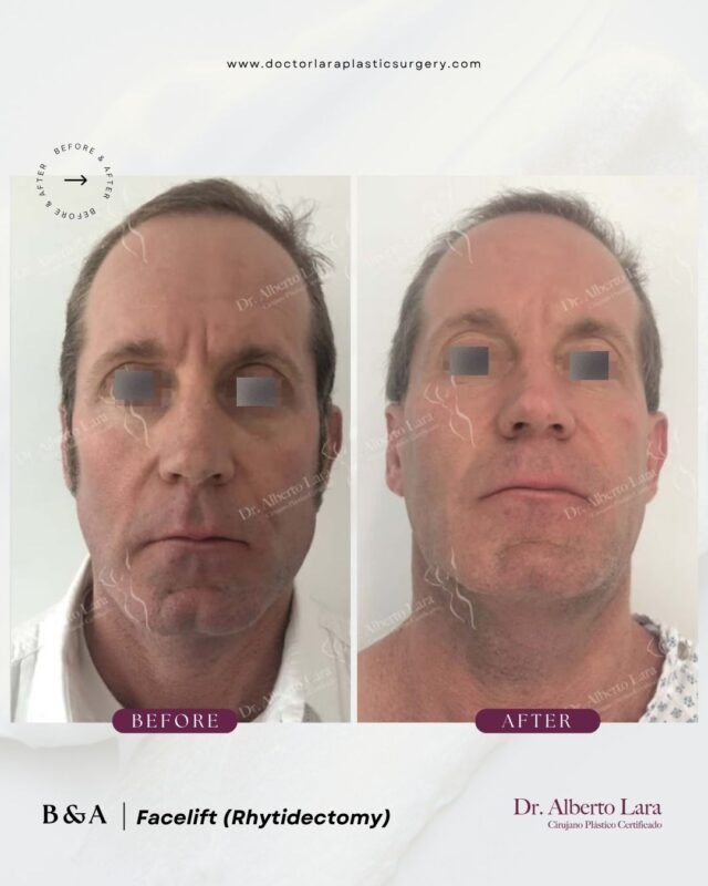 Facelift (Rhytidectomy)